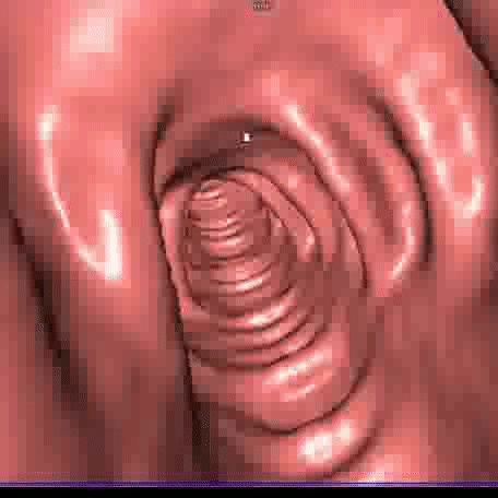 SRT-Colonscopia