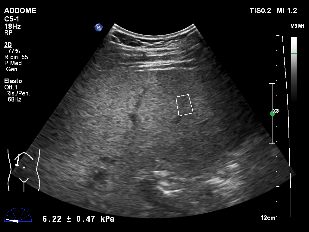 SRT-Fibroscan01